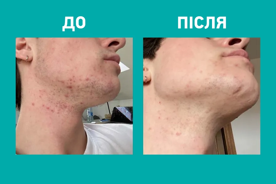 Przed i po zastosowaniu kosmetyku Yun na twarzy z niedoskonałościami.