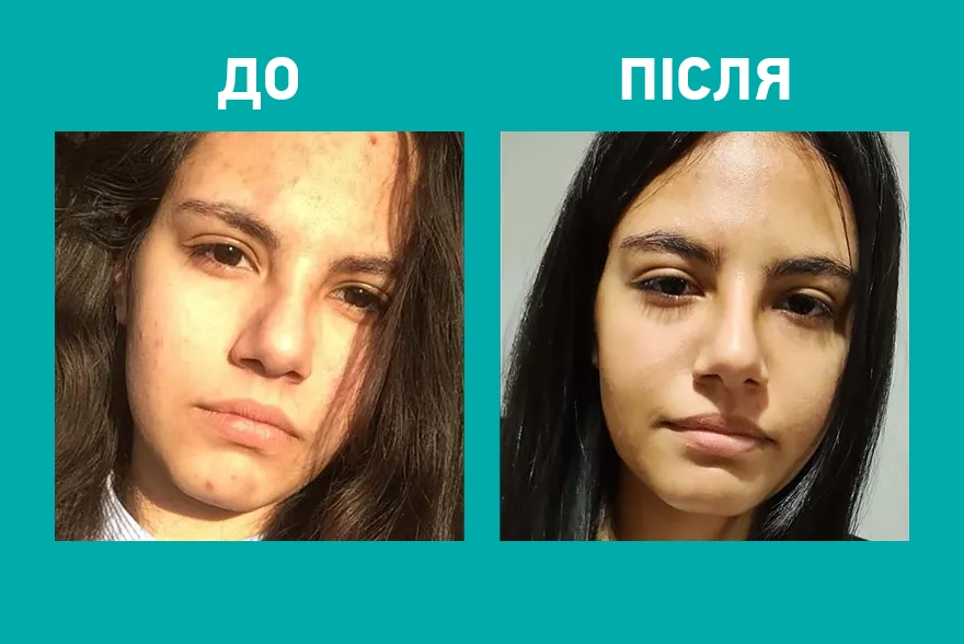 Przed i po zastosowaniu kosmetyku Yun na twarzy z niedoskonałościami.